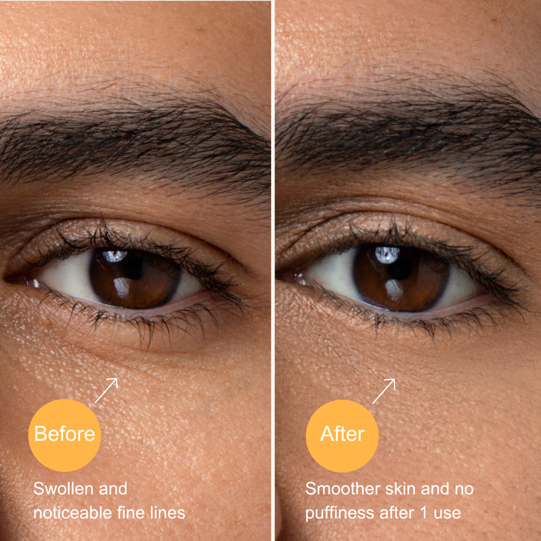 Clean circle before and after image on depuffing eye masks. The before image shows more noticeable fine lines and the after image shows smoother and less puffiness under eyes 